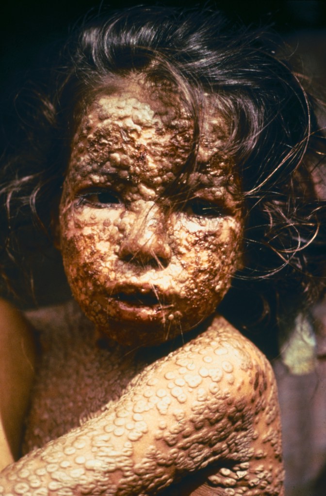 A child with covered by severe blisters.